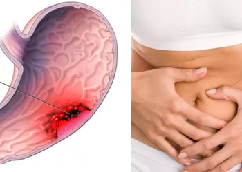 Cancerul la stomac: ucigașul tăcut. Iată care sunt cele mai frecvente simptome care trebuie să te îngrijoreze