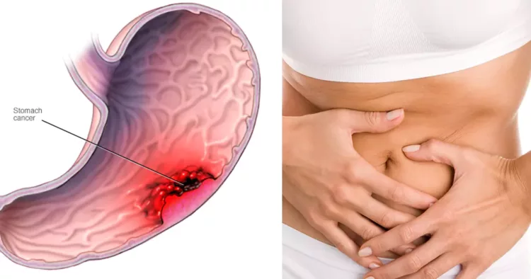 Cancerul la stomac: ucigașul tăcut. Iată care sunt cele mai frecvente simptome care trebuie să te îngrijoreze