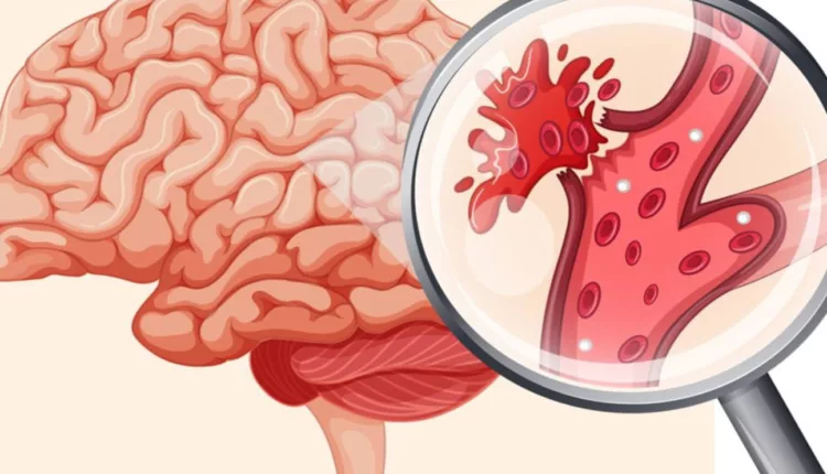 Poti sa ai un accident vascular cerebral(AVC) si tu sa nici nu stii. La ce trebuie sa fii atent