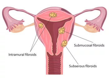 Ce simptome dă fibromul uterin și cum poate fi eliminat în jumătate de oră, fără operație