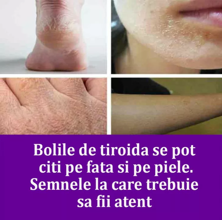 Bolile de tiroida se pot citi pe fata si pe piele. Semnele la care trebuie sa fii atent