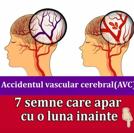 Primele SIMPTOME care apar Cu 1 LUNĂ înainte de ACCIDENTUL VASCULAR CEREBRAL(AVC)