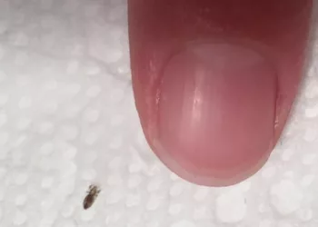 Soția a găsit asta în părul copilului nostru mic. Ar trebui să ne facem griji?