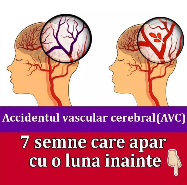 Semnalele tăcute ale unui accident vascular cerebral: simptome care pot apărea cu o lună înainte de AVC