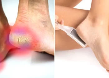 De ce ți se crapă călcâiele și cum poți remedia rapid problema cu un truc ieftin