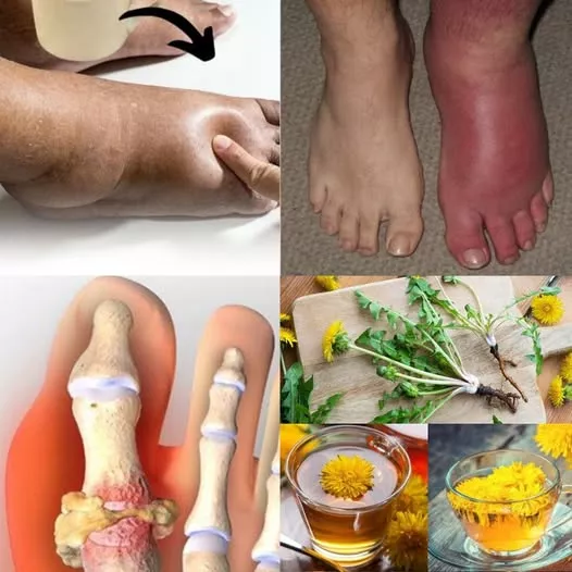 Picioare umflate? Încearcă acest ceai natural care elimină retenția de apă și îmbunătățește circulația