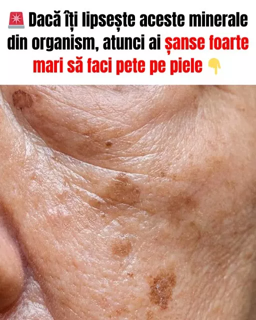 Petele maronii pe piele: de ce apar și cum le putem preveni