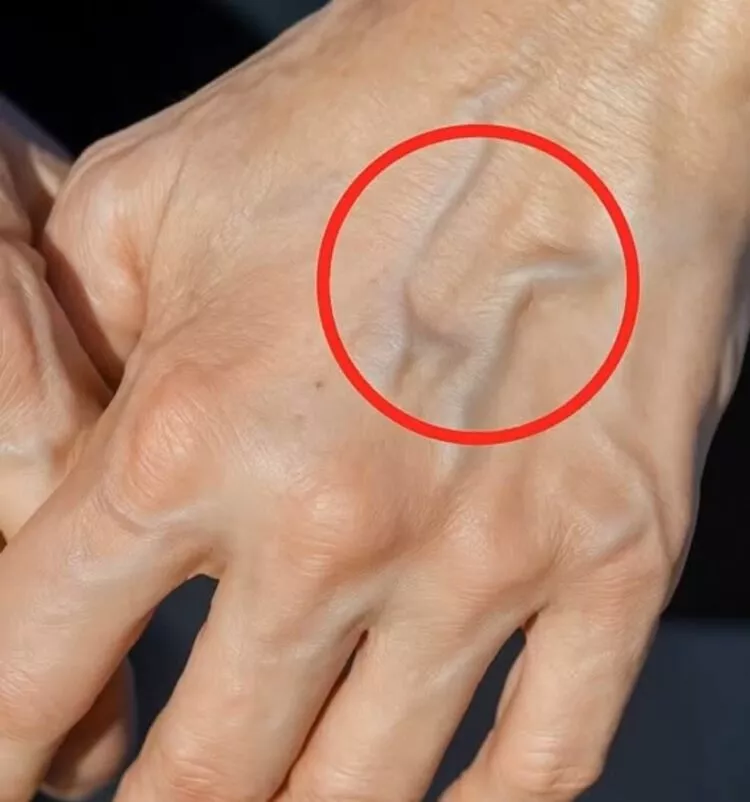 Vene Vizibile: Când Sunt Normale și Când Semnalează o Problemă de Sănătate