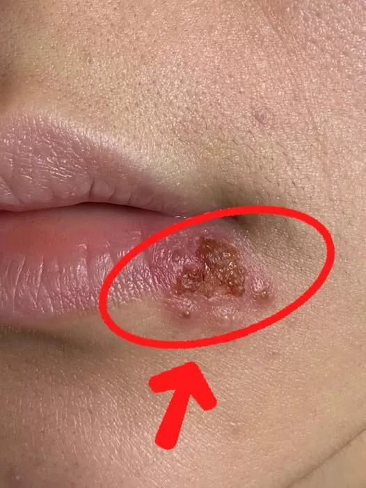 Nu Ignora Semnele: Ghid Complet pentru Cancerul Oral (Cavitatea Bucală) – Simptome de Alarmă și Prevenție