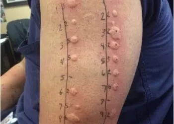 De la o mâncărime banală la un diagnostic neașteptat: