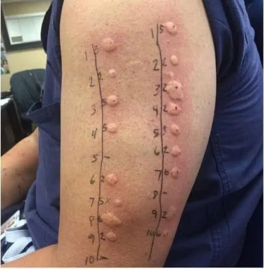 De la o mâncărime banală la un diagnostic neașteptat: