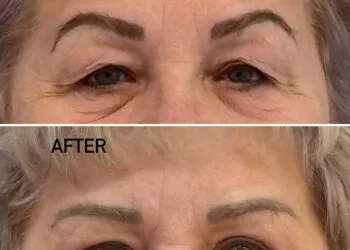 Blefaroplastie