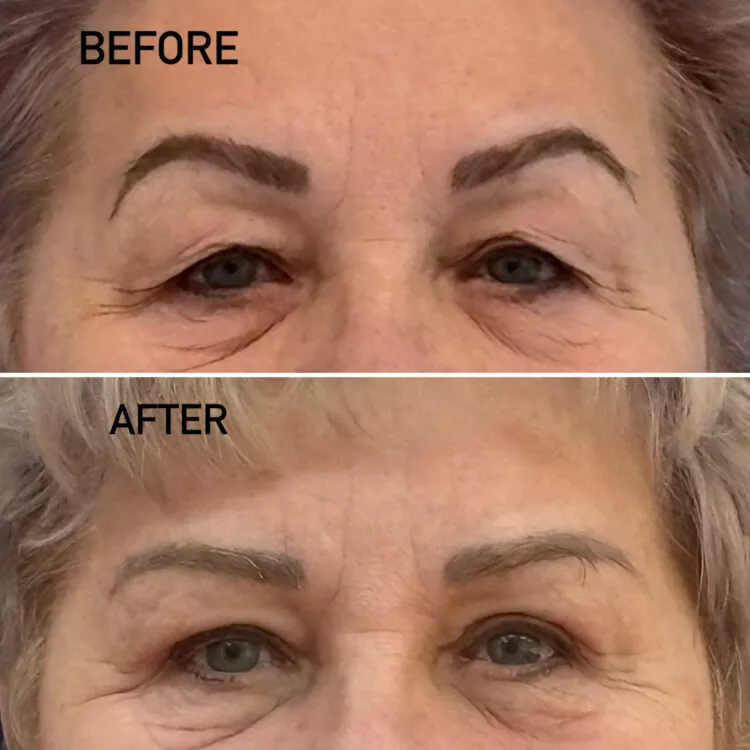 Blefaroplastie
