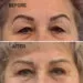 Blefaroplastie