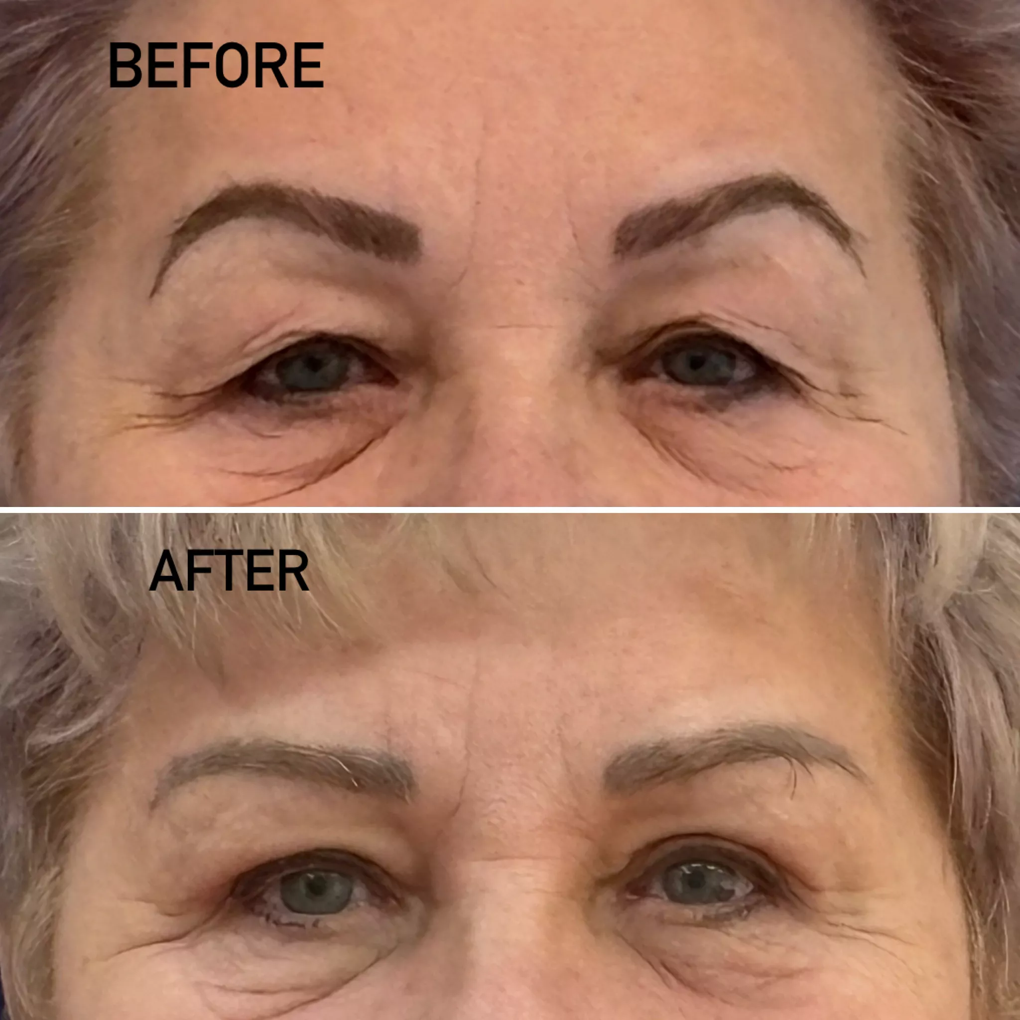 Blefaroplastie 