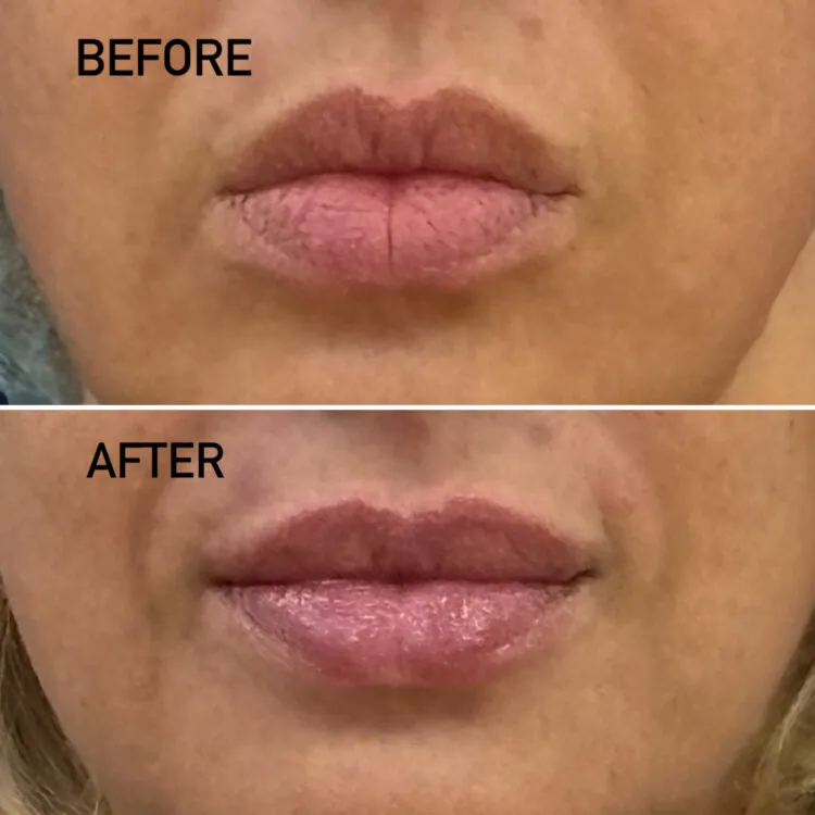 Injectarea buzelor cu acid hialuronic: Tot ce trebuie să știi înainte de procedură