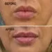 Injectarea buzelor cu acid hialuronic: Tot ce trebuie să știi înainte de procedură