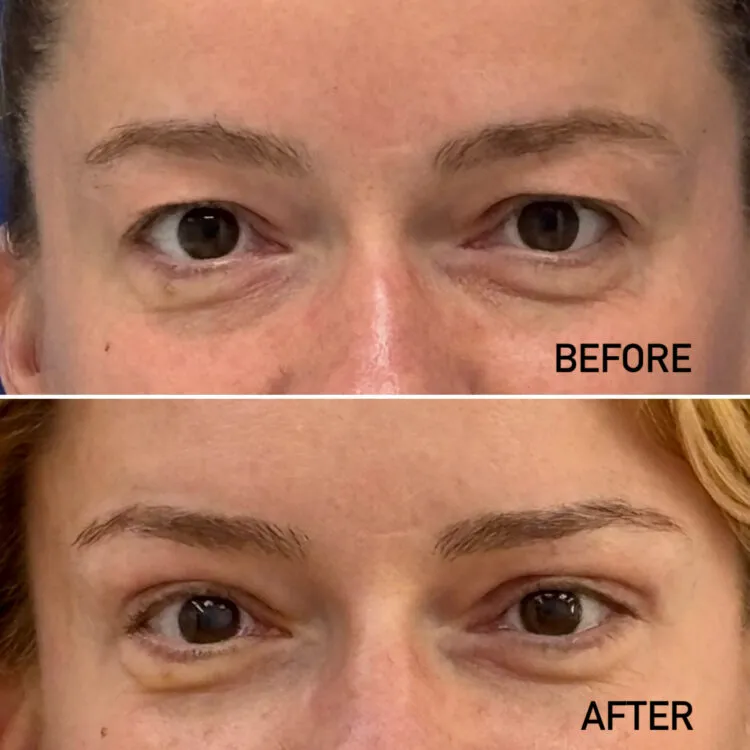 Rejuvenarea completă a treimii superioare a feței: lifting endoscopic de sprâncene asociat cu blefaroplastie superioară și transfer de grăsime