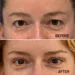 Rejuvenarea completă a treimii superioare a feței: lifting endoscopic de sprâncene asociat cu blefaroplastie superioară și transfer de grăsime